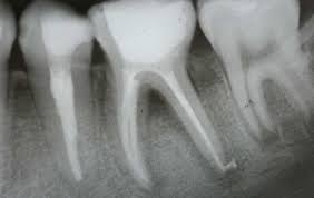 endodonti
