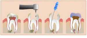 endodonti2
