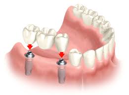 implant2