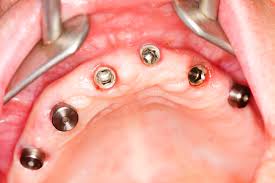 implant3